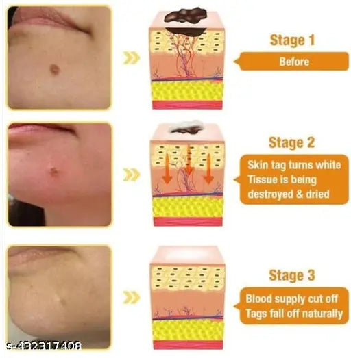 DermaSmooth Skin Tag Remover Patch β Fast, Safe & Painless Solution